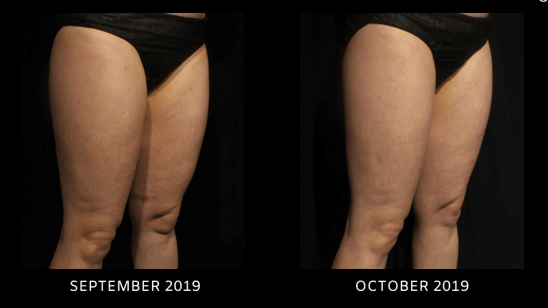 EMtone before and afters